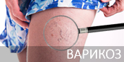 Полезные статьи о варикозе и тромбофлебите Варикоз и тромбофлебит
