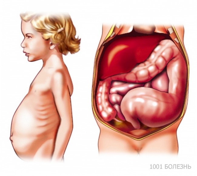Мегаколон токсический. Симптомы, диагностика и лечение мегаколона токсического.